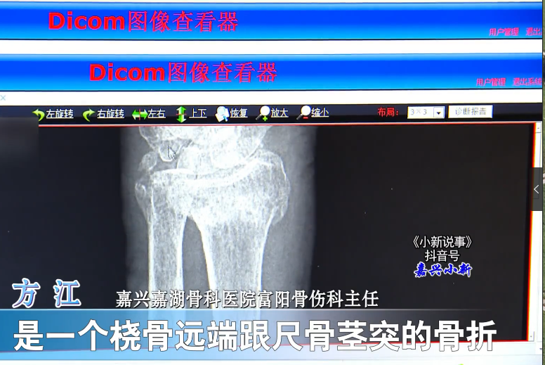 97歲高齡老人，傳統(tǒng)復(fù)位免于手術(shù)3.png